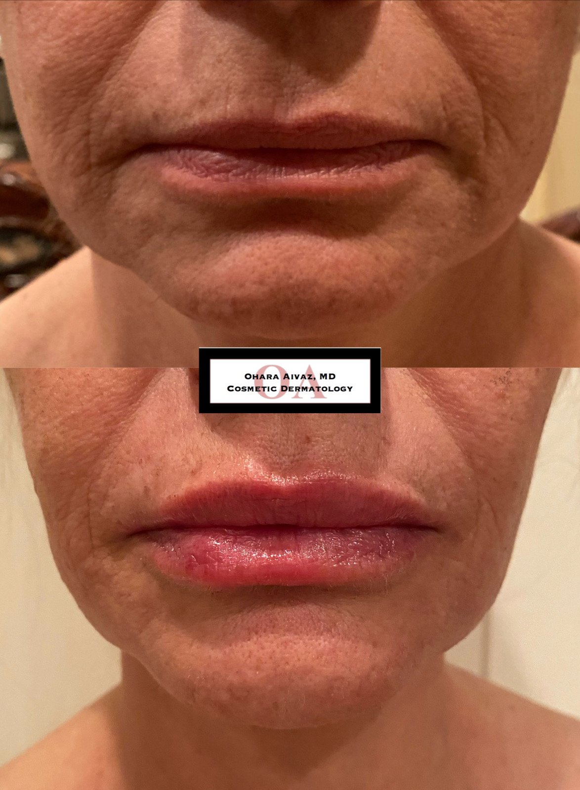 Close-up before and after comparison of a woman’s lips following cosmetic lip filler treatment performed by Dr. Ohara Aivaz, board-certified dermatologist.