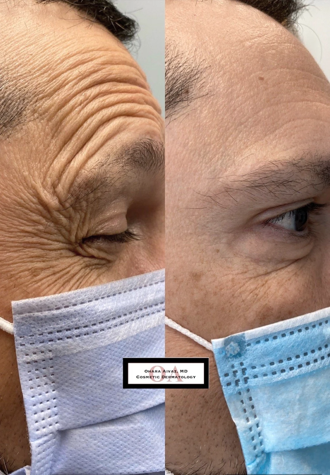 Botox before/after