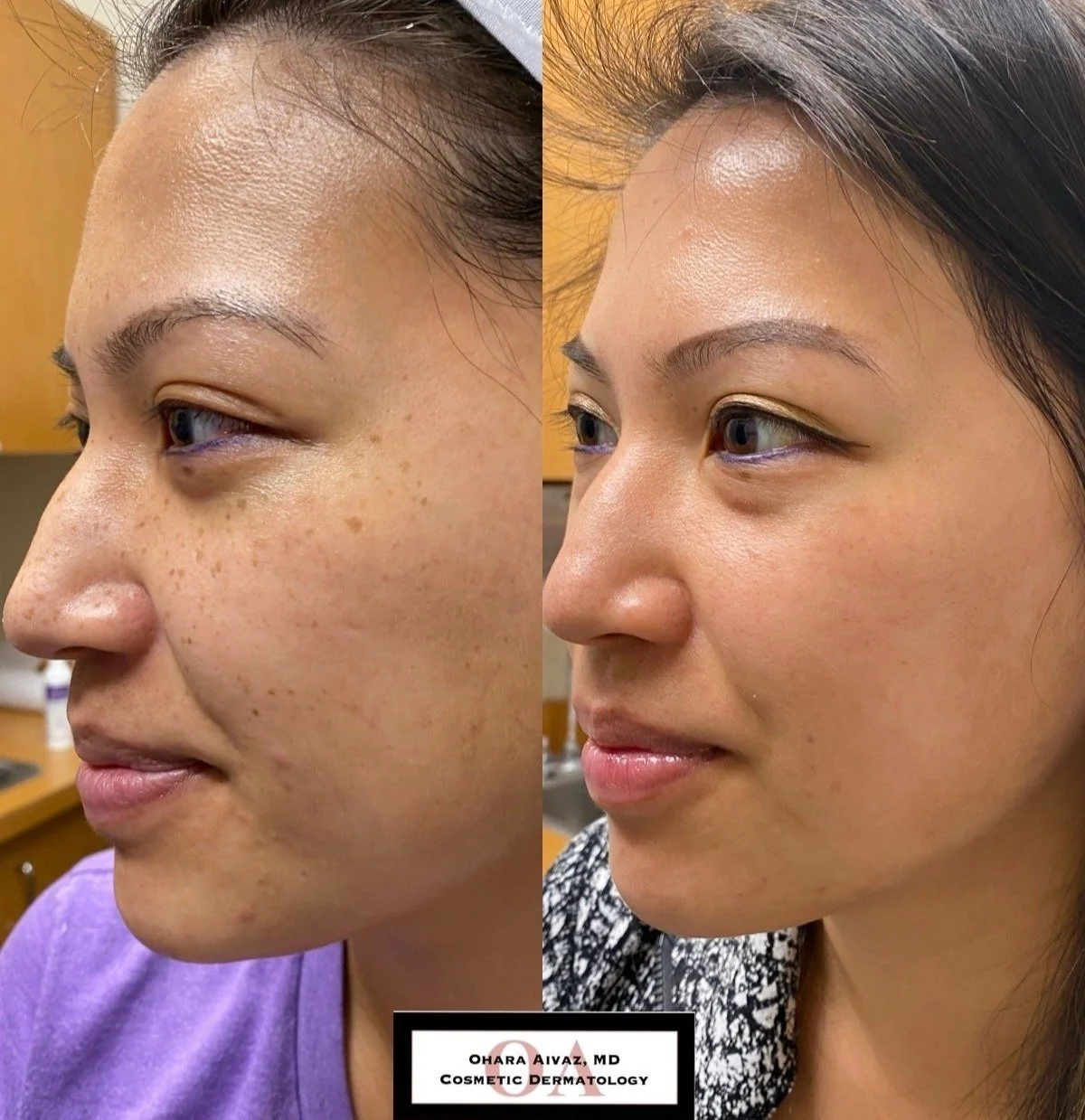 Side-by-side before and after comparison of a woman’s face following a single IPL treatment to reduce freckles and pigmentation, showing improved skin tone and texture.