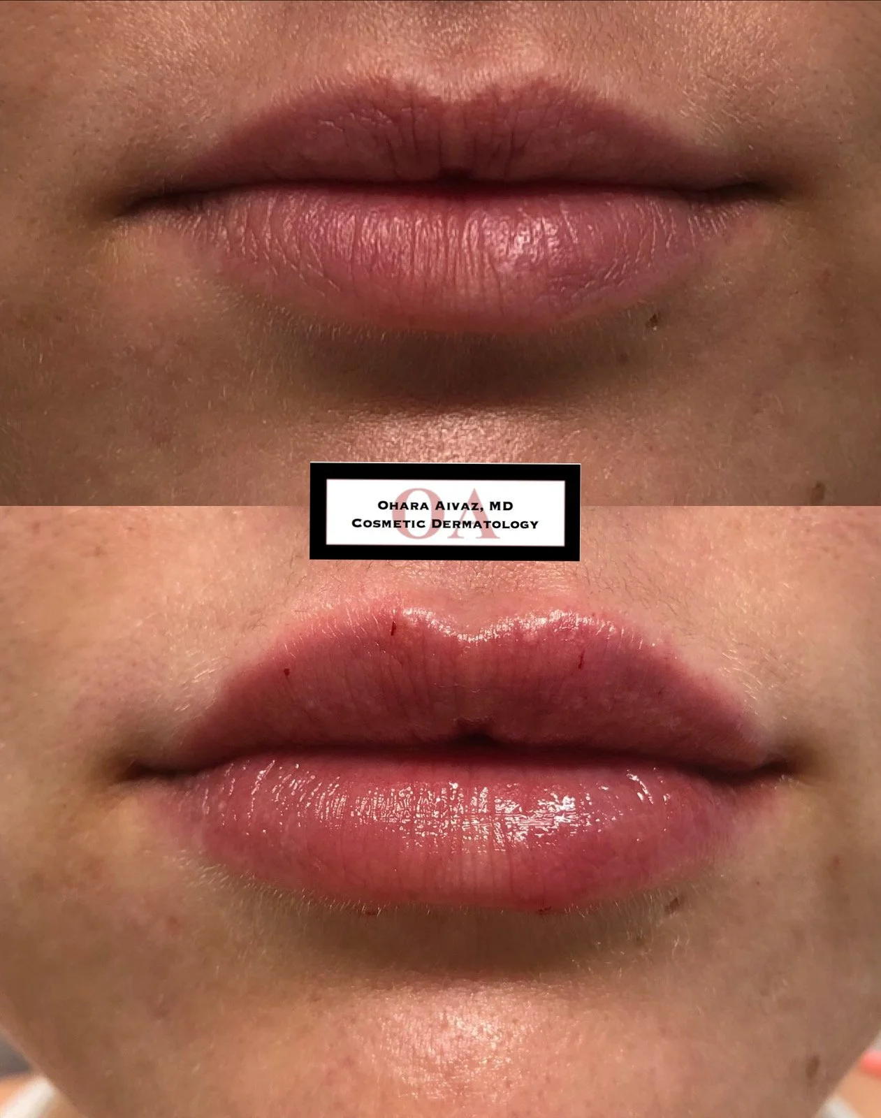 Close-up before and after comparison of a woman’s lips following cosmetic lip filler treatment performed by Dr. Ohara Aivaz, board-certified dermatologist.