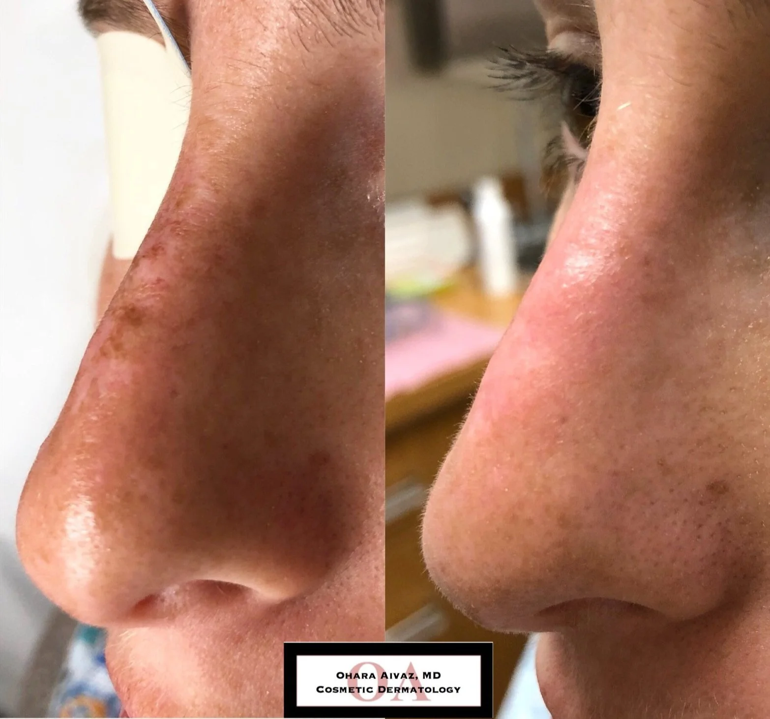 Close-up before and after comparison of a person’s nose following two vascular laser treatment sessions to address a broken capillary (spider angioma), showing improved skin texture and appearance.