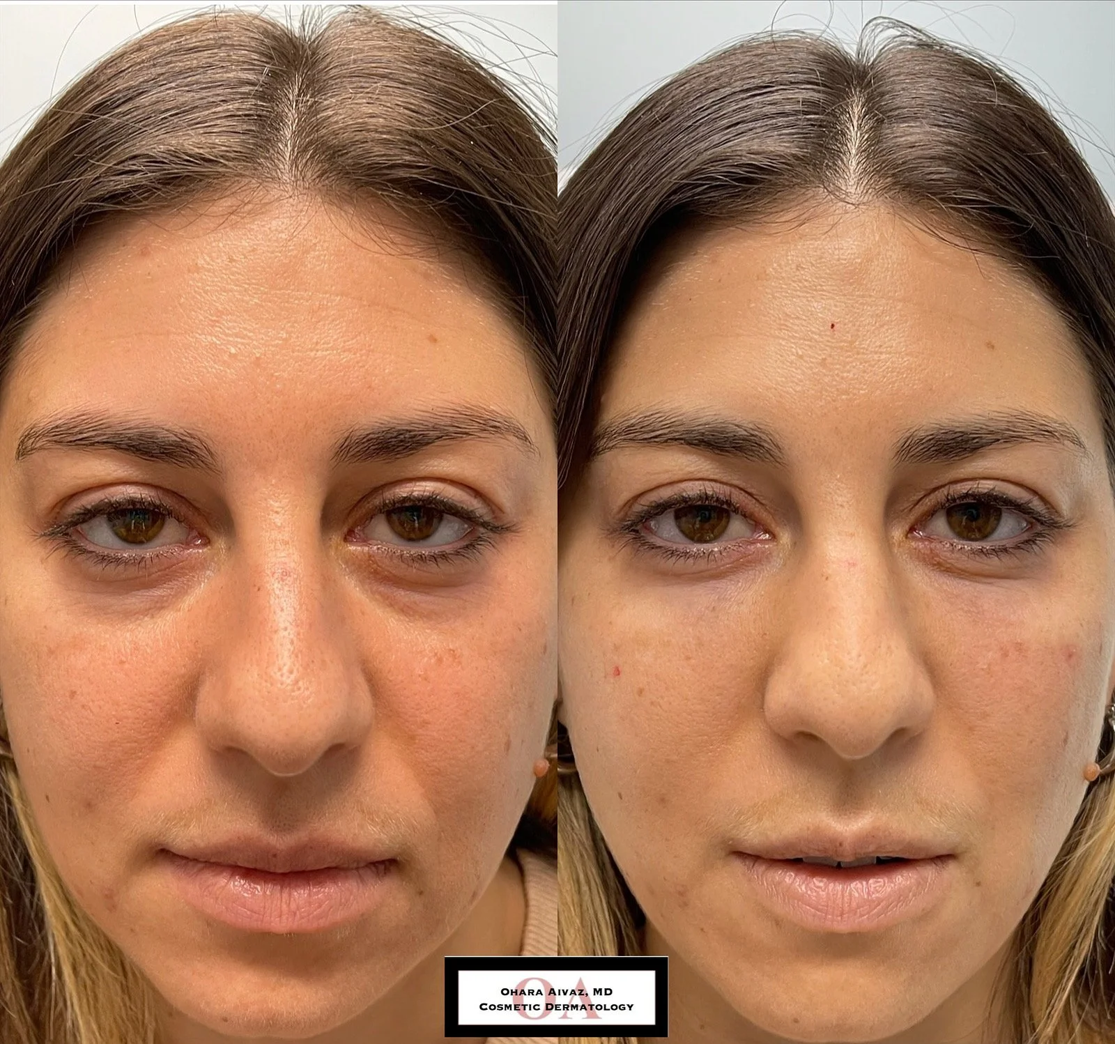 Side-by-side before and after comparison of a woman’s face following under-eye dermal filler treatment, showing improved skin clarity and reduced facial redness across the forehead, cheeks, and eye area.