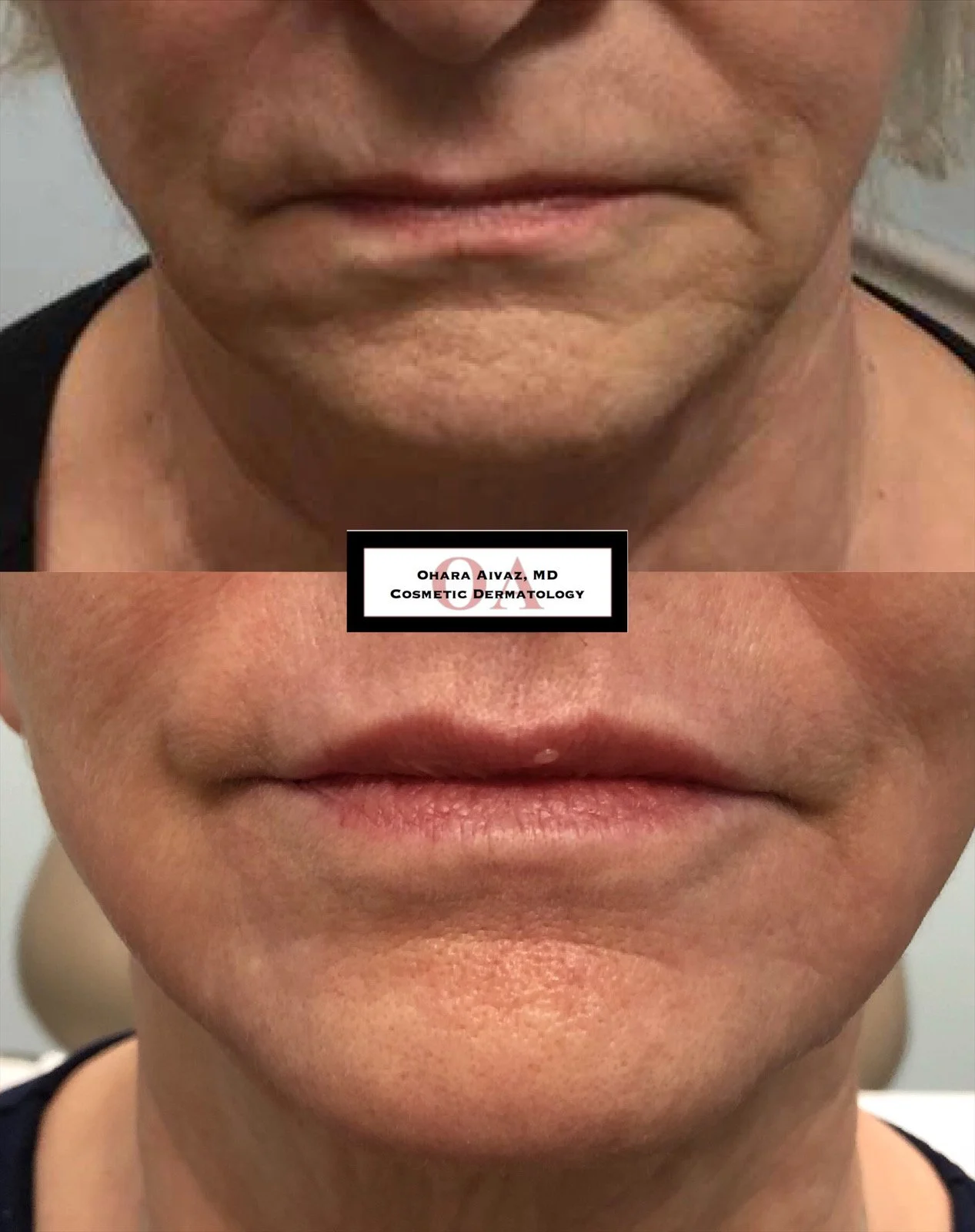 Close-up before and after comparison of a woman’s lips following cosmetic lip filler treatment performed by Dr. Ohara Aivaz, board-certified dermatologist.