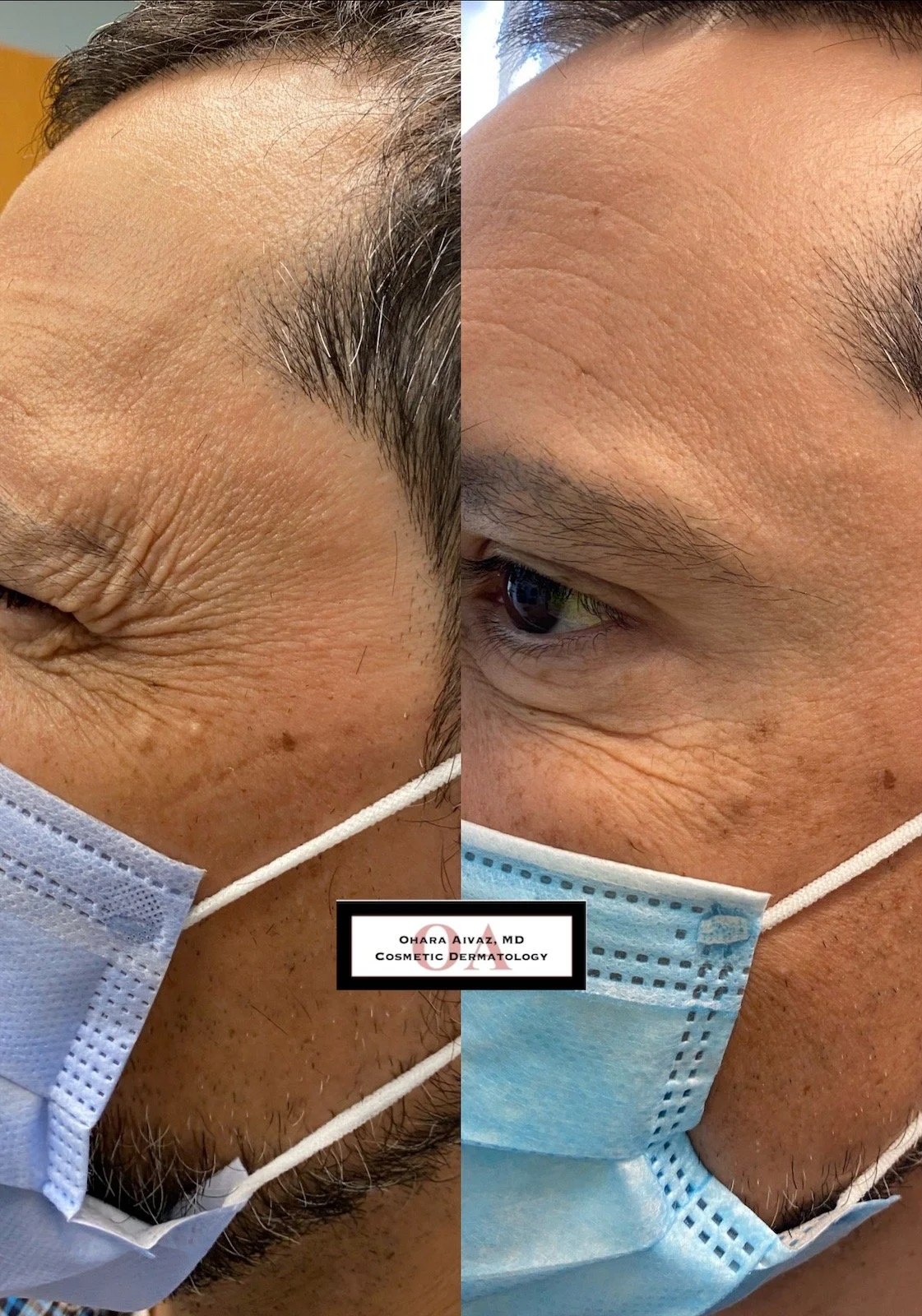 Side-by-side before and after comparison of a man’s face and eye area following cosmetic neurotoxin treatment performed by Dr. Ohara Aivaz, MD, showing reduced forehead and eye wrinkles and improved skin texture.