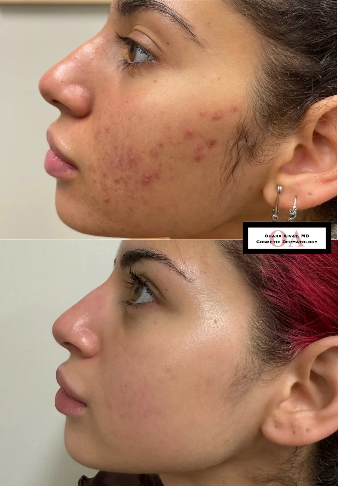 Before and after images of a woman’s face following a course of Accutane treatment, showing improvement in acne, redness, and overall skin clarity.