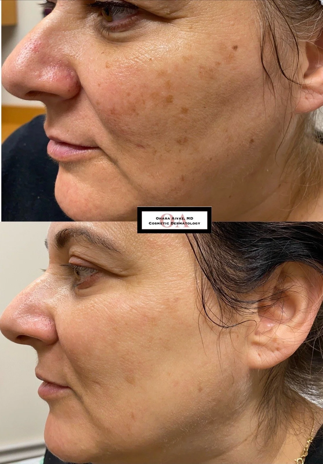 A before-and-after comparison of a woman's face showing the reduction of hyperpigmentation and skin imperfections after skincare treatment.