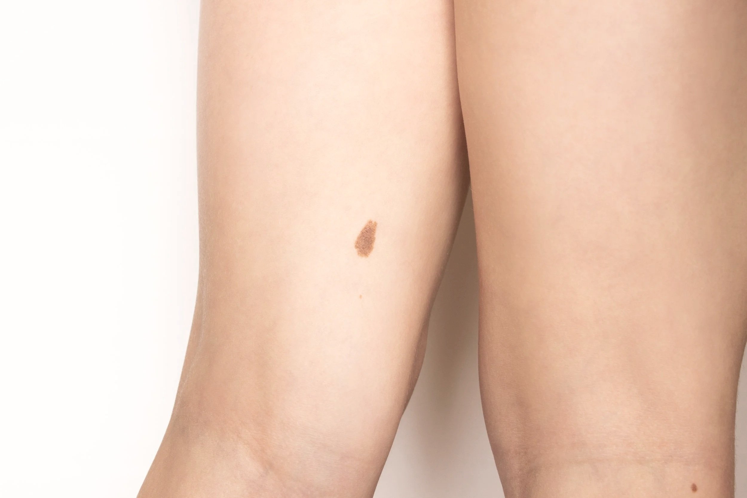 Close-up of a person’s upper thigh and hip showing a brown birthmark prior to dermatologic evaluation and removal.