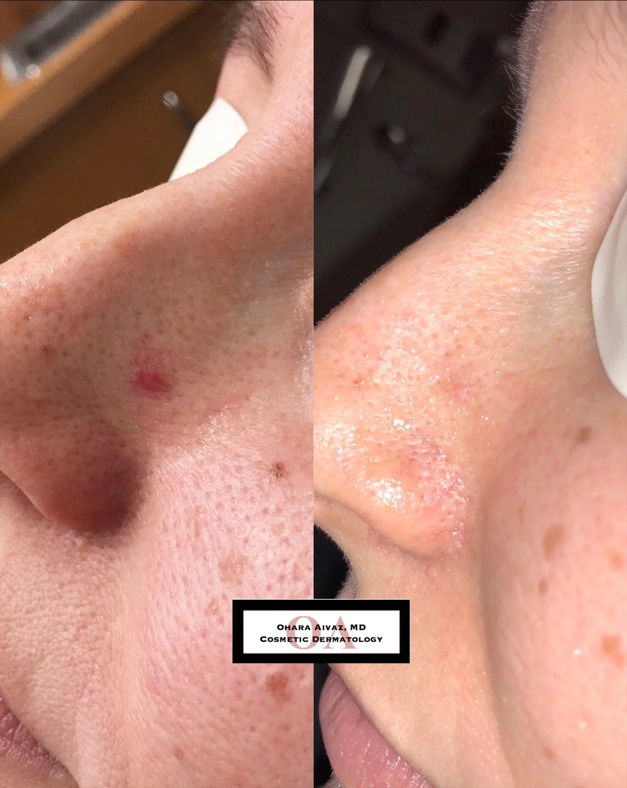 Before and after comparison of a patient’s nose following two IPL sessions combined with radiofrequency microneedling to treat pigmentation, broken capillaries, and scarring.