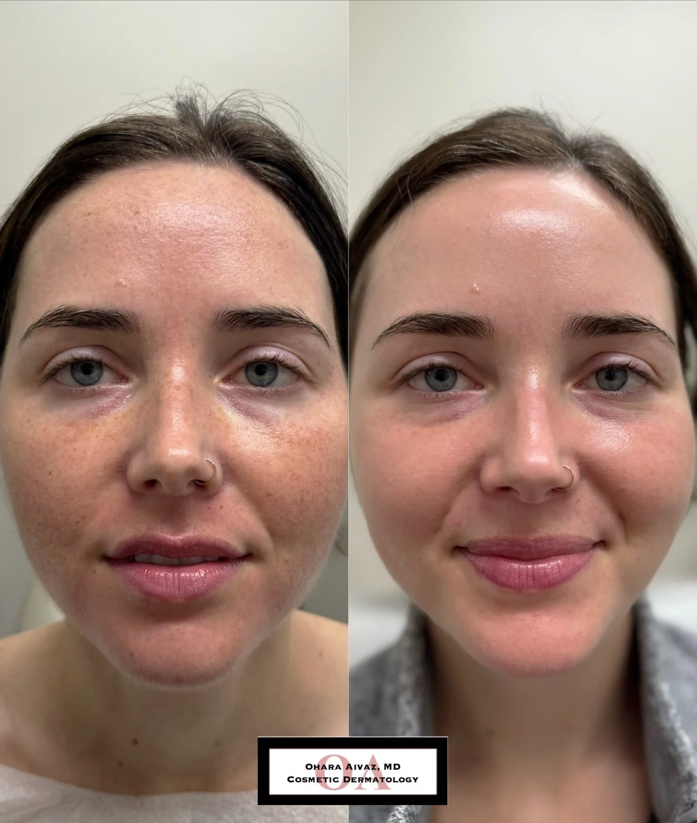 Side-by-side before and after comparison of a woman’s face following a single IPL treatment to reduce freckles and pigmentation, showing improved skin tone and texture.