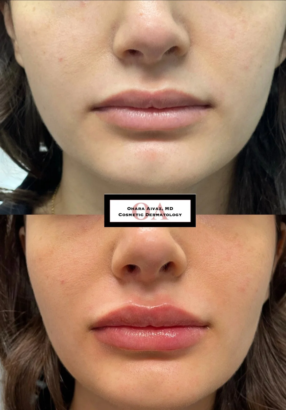 Close-up before and after comparison of a woman’s lips following cosmetic lip filler treatment performed by Dr. Ohara Aivaz, board-certified dermatologist.
