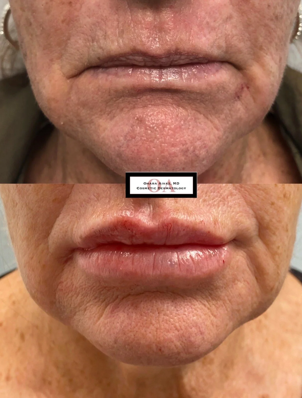 restylane juvederm filler