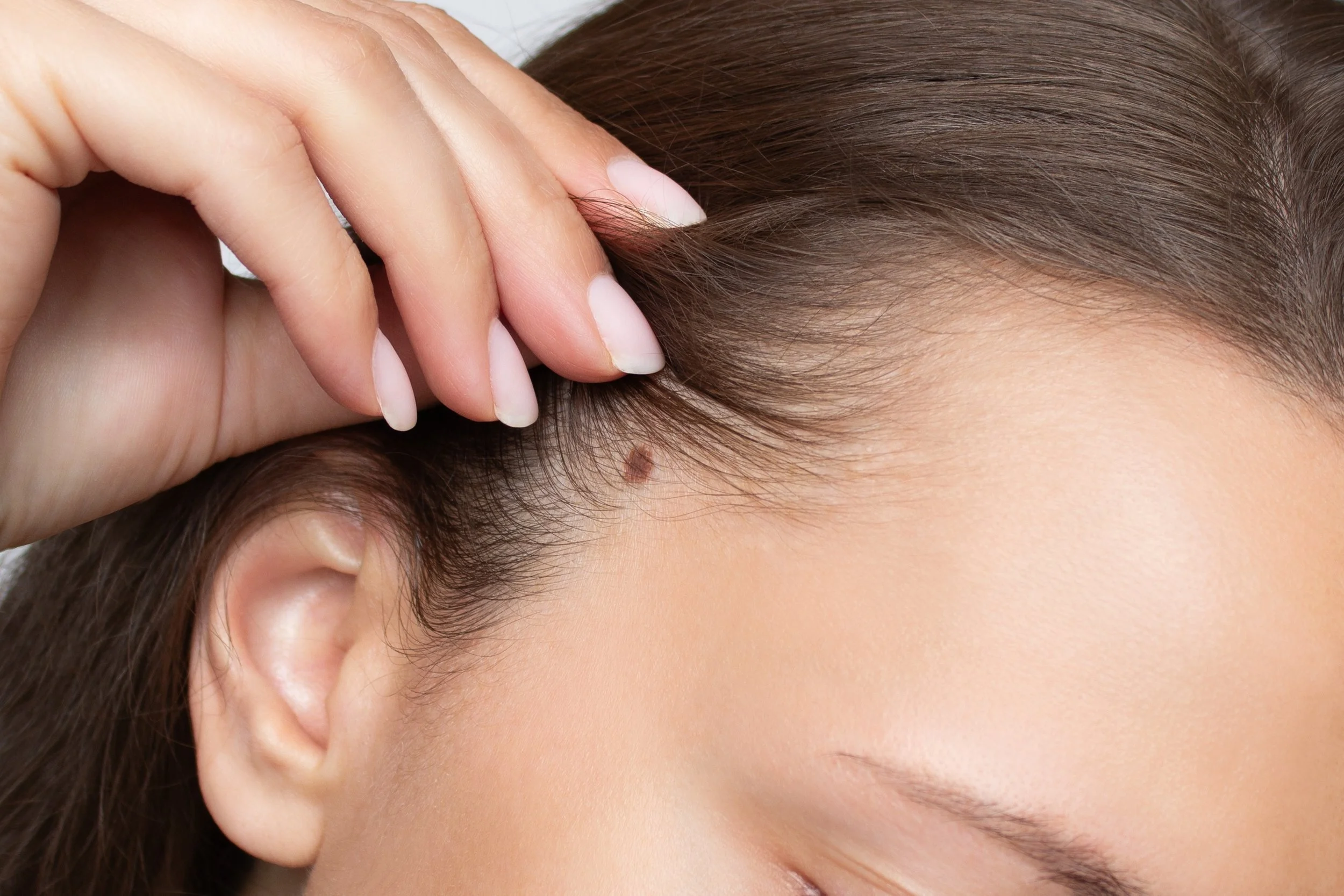 Close-up of a woman’s ear and scalp showing a brown birthmark on the scalp prior to dermatologic evaluation and removal.