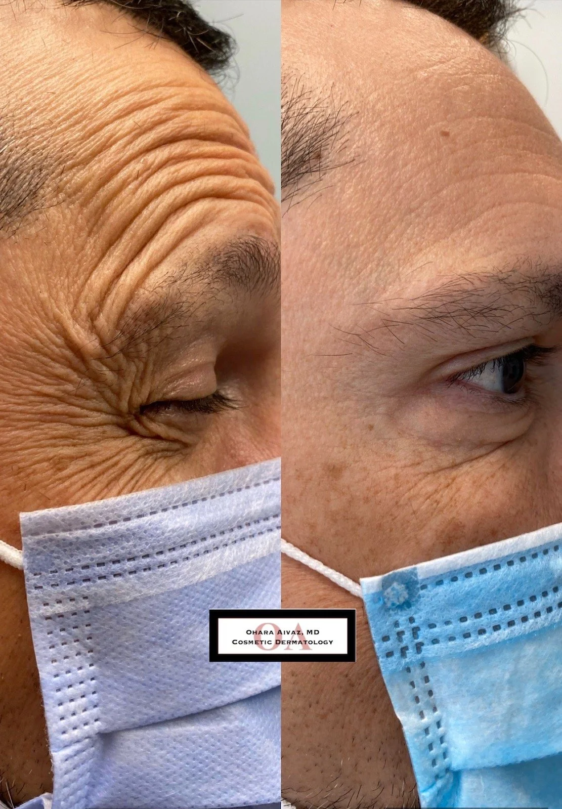 Before and after comparison of a person’s eye area following cosmetic neurotoxin treatment, showing reduced appearance of wrinkles, performed by Dr. Ohara Aivaz, MD.