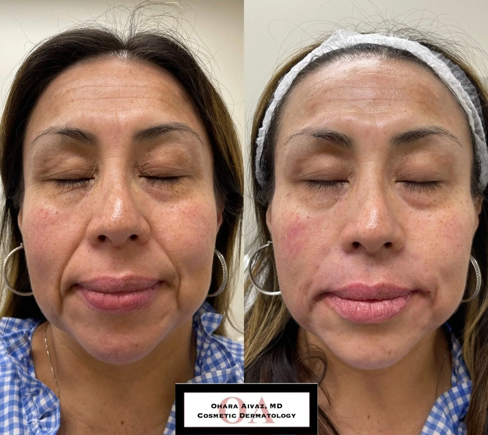 restylane juvederm filler