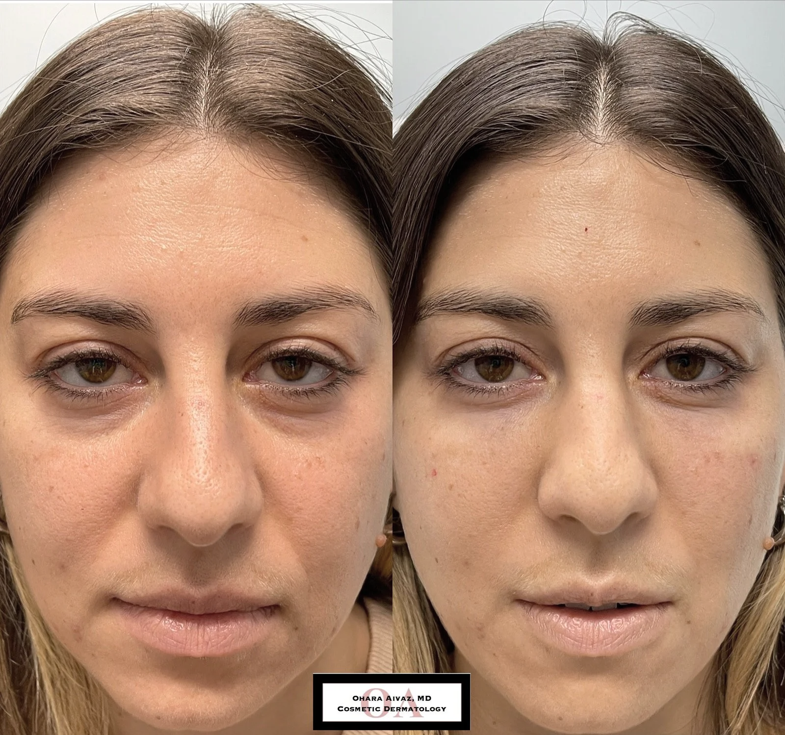 Before and after comparison of a woman following under-eye dermal filler treatment to improve the appearance of tear troughs and under-eye hollows.