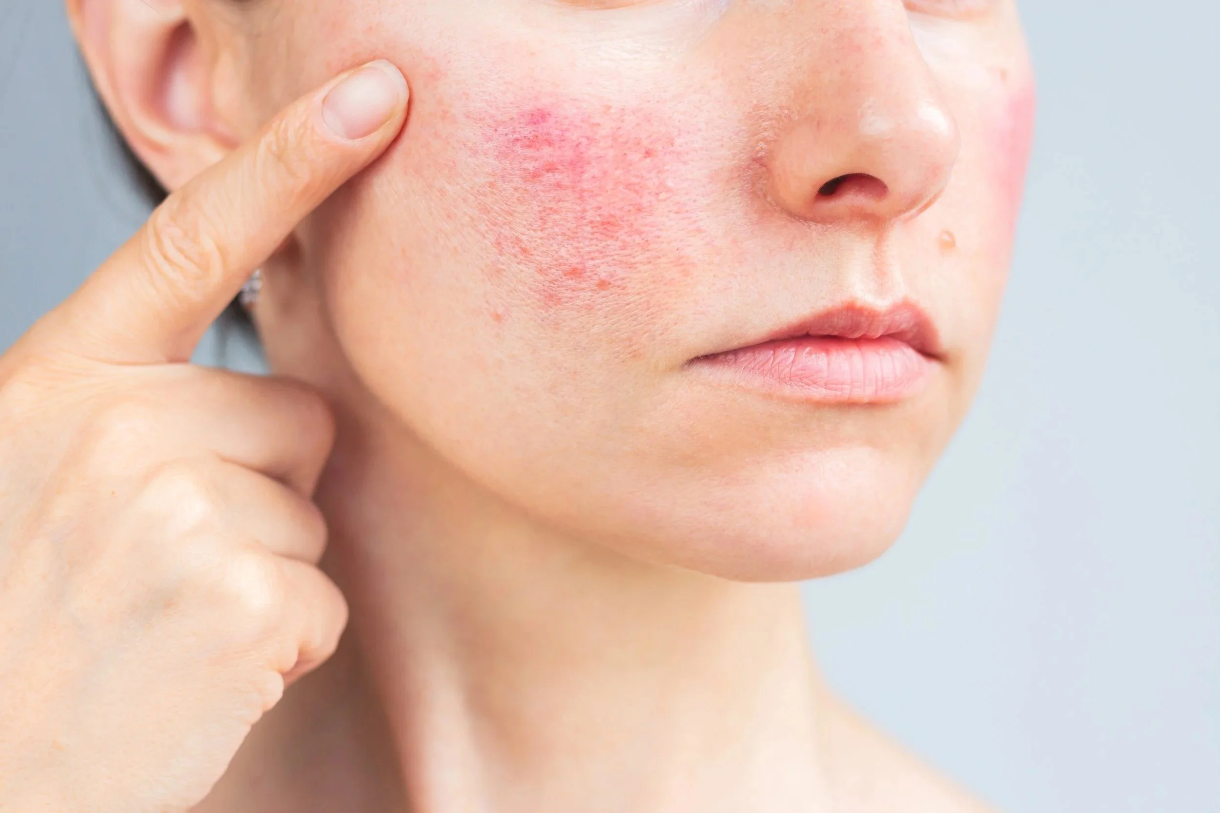 Person touching a red, irritated cheek showing facial skin inflammation associated with rosacea before dermatologic treatment.