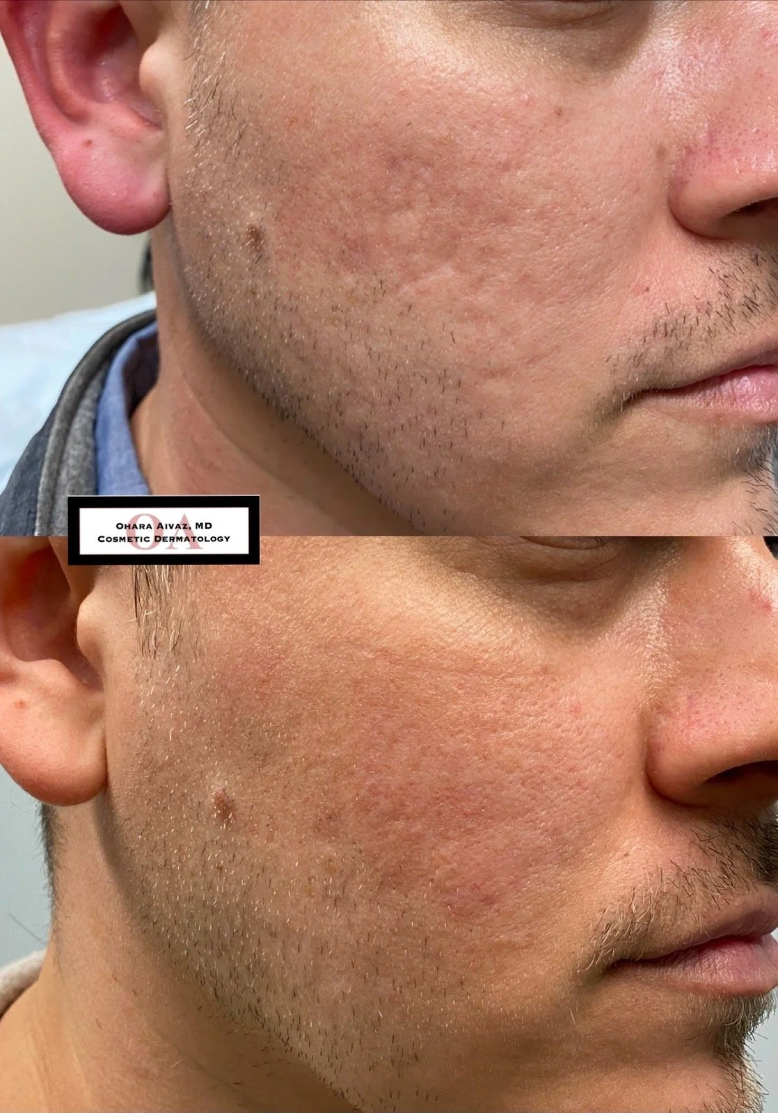 Before and after comparison of a man’s lower face following radiofrequency microneedling and dermal filler treatment for acne scarring, showing smoother skin texture and reduced pore appearance.