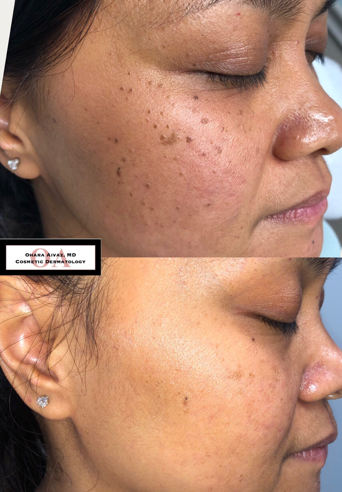 Before and after comparison of a woman's face before and after facial treatment, showing reduced hyperpigmentation and clearer skin.
