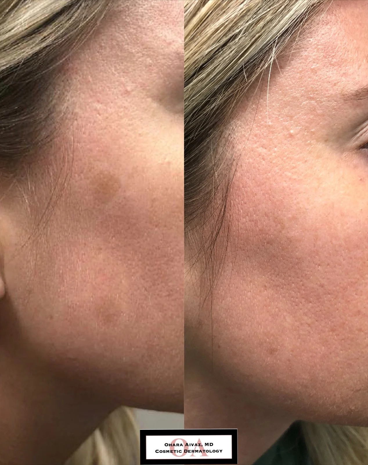 Before and after close-up comparison of a woman’s cheek following cryotherapy treatment to remove brown pigmentation, performed by Dr. Ohara Aivaz, MD, cosmetic dermatologist.