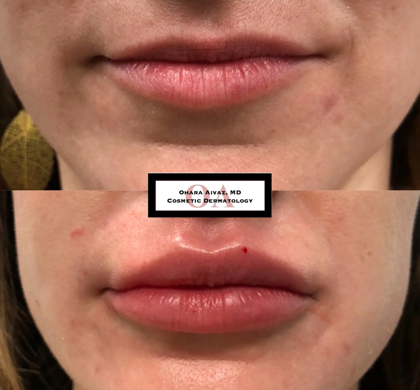 Close-up before and after comparison of a woman’s lips following cosmetic lip filler treatment performed by Dr. Ohara Aivaz, board-certified dermatologist.