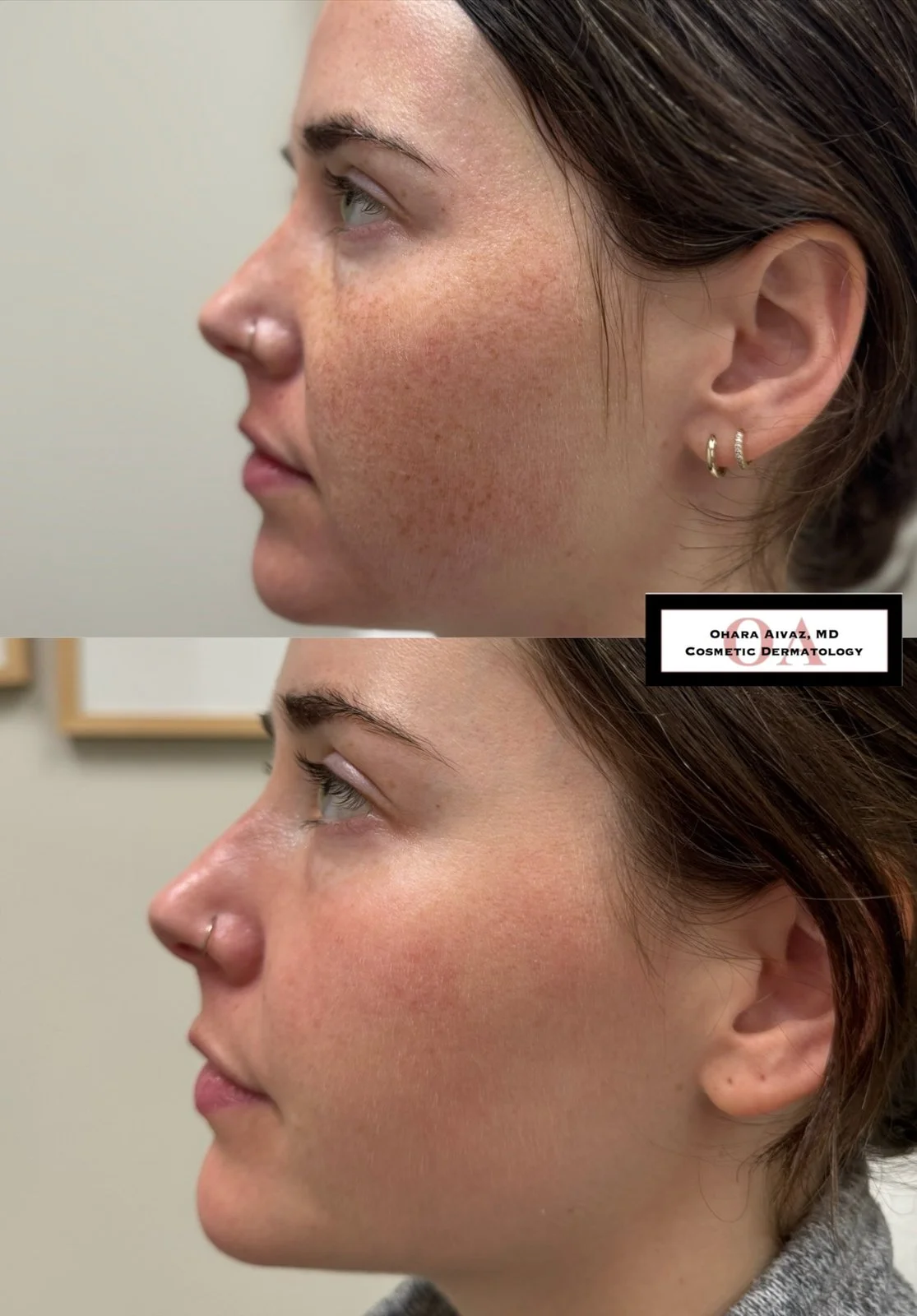 Before and after comparison of a woman’s face following a single IPL treatment to reduce freckles and pigmentation, showing improved skin tone and texture.