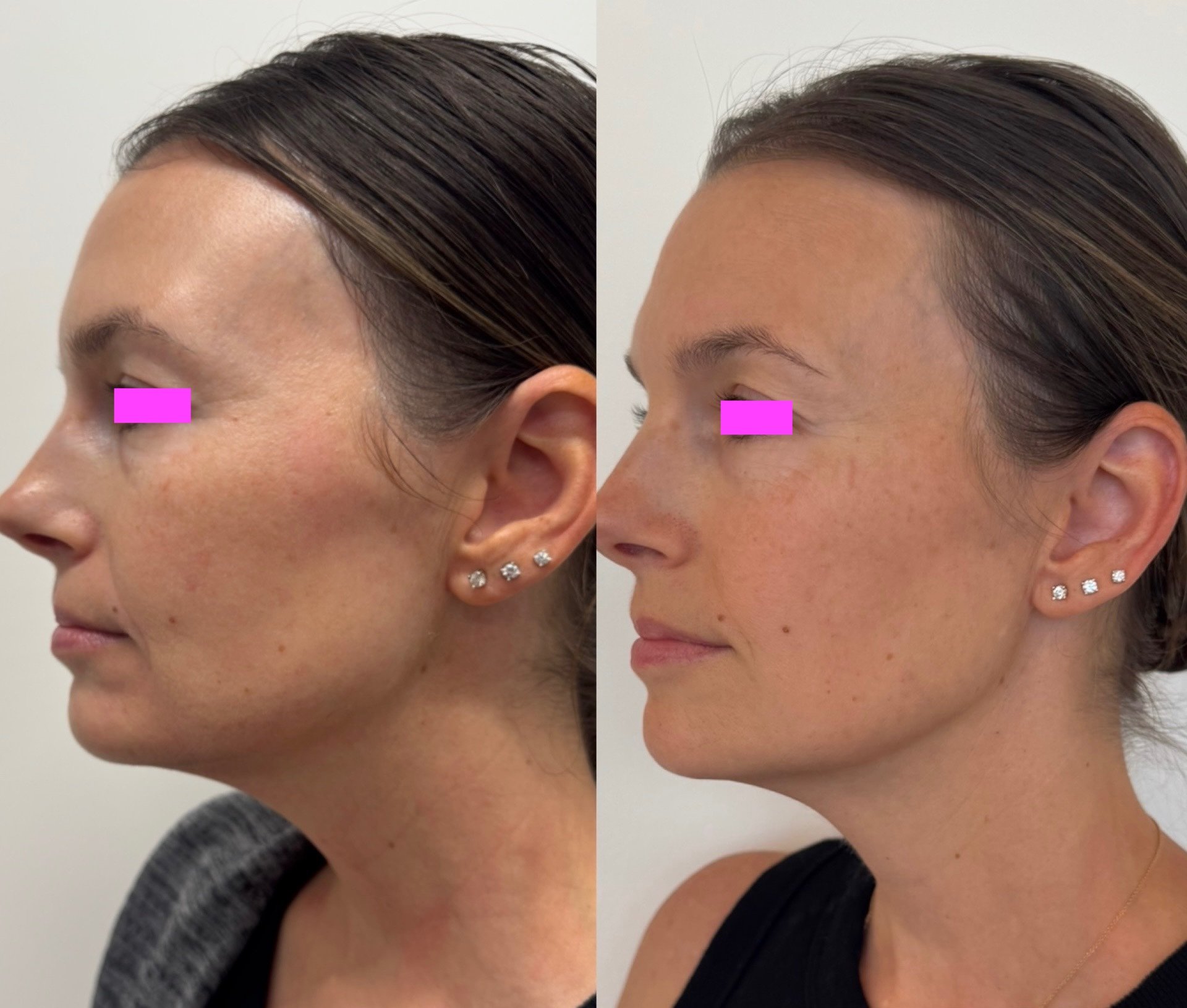 Side-by-side before and after comparison of a woman’s face following Ultherapy treatment, showing improved skin texture and overall appearance.