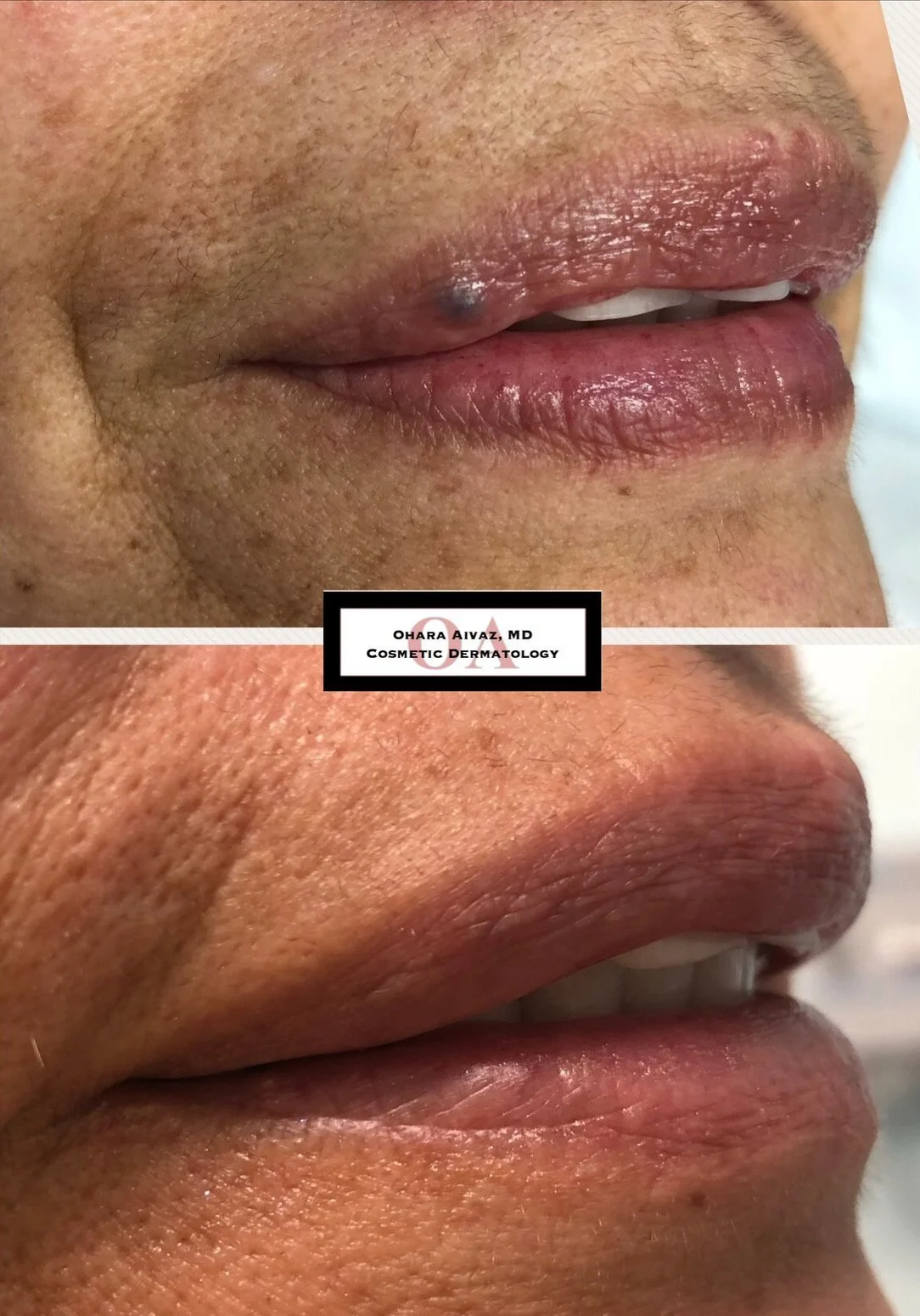 Close-up before and after comparison of a woman’s lips following cosmetic lip filler treatment performed by Dr. Ohara Aivaz, board-certified dermatologist.