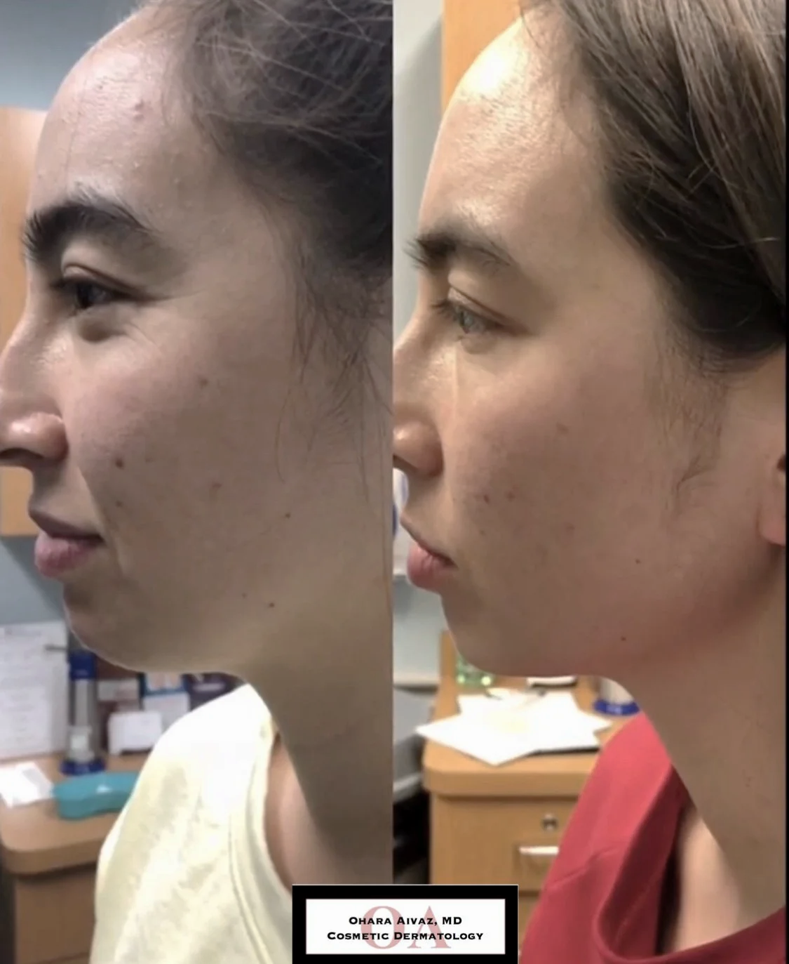 Side-by-side before and after comparison of a woman’s face following Kybella treatment for double chin reduction and jawline enhancement, showing improved skin texture and reduced pigmentation.