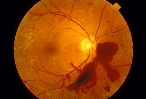 diabetic macular edema