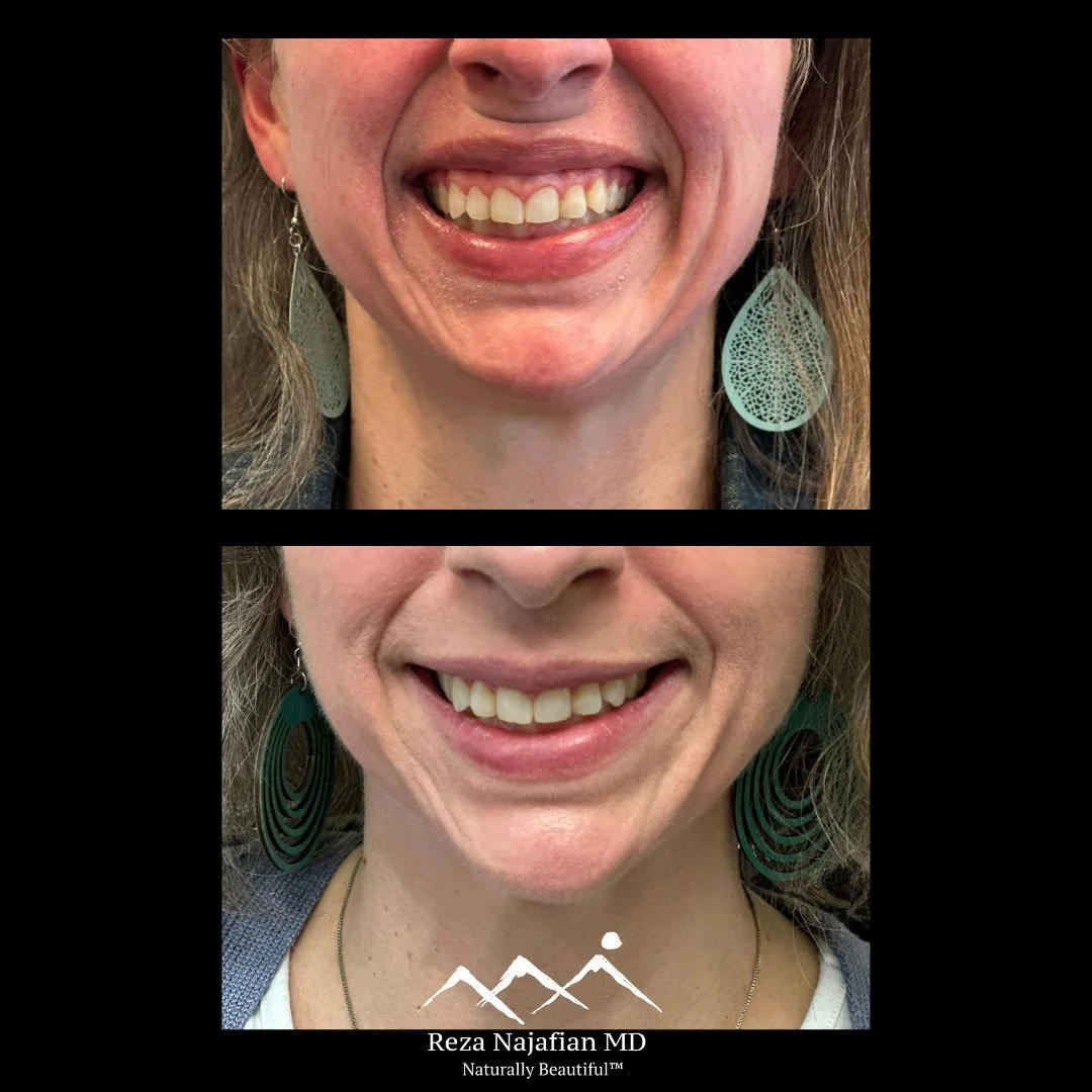 Ditch the Gummy Smile: How Botox Delivers a Natural, Confident Smile in Minutes
