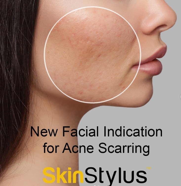 Microneedling