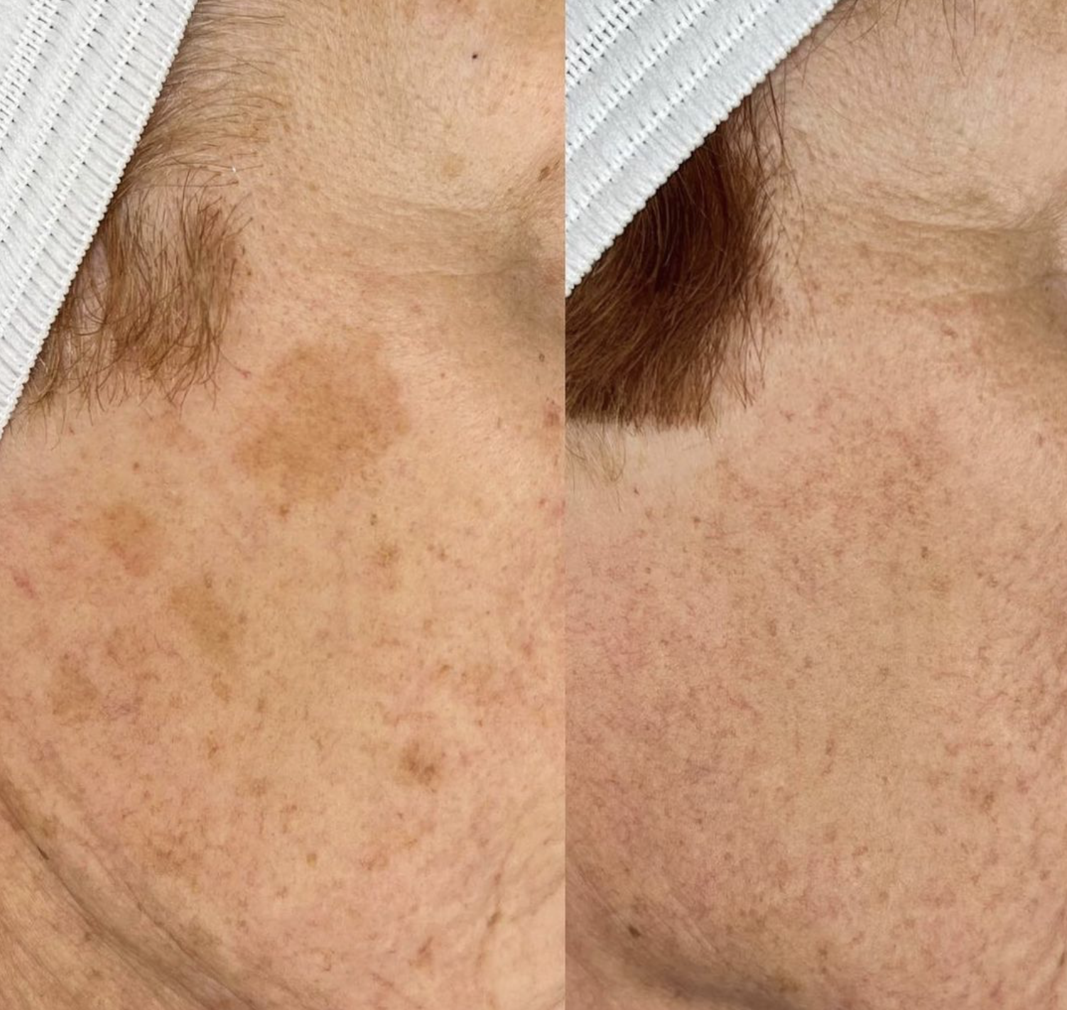 2 sessions  @kd_permanentcosmetics _ age spots .png