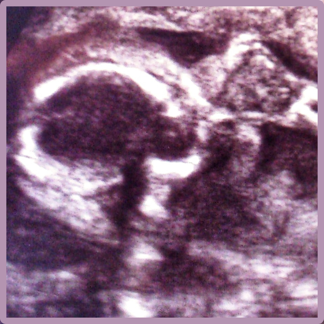 Pregnancy: carried before birth