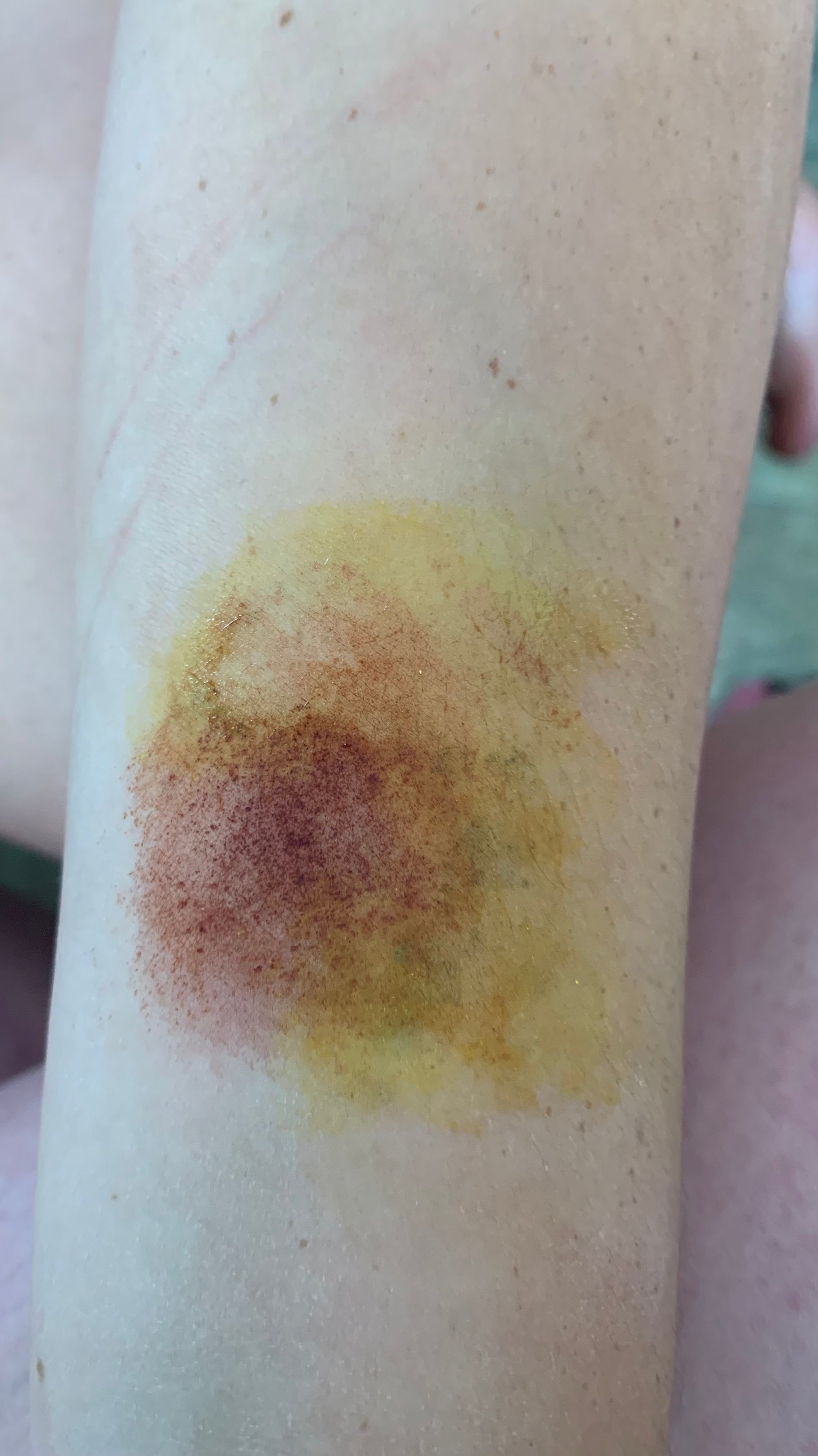 Bruise+Aug+17%2C+2021+%281%29.jpg