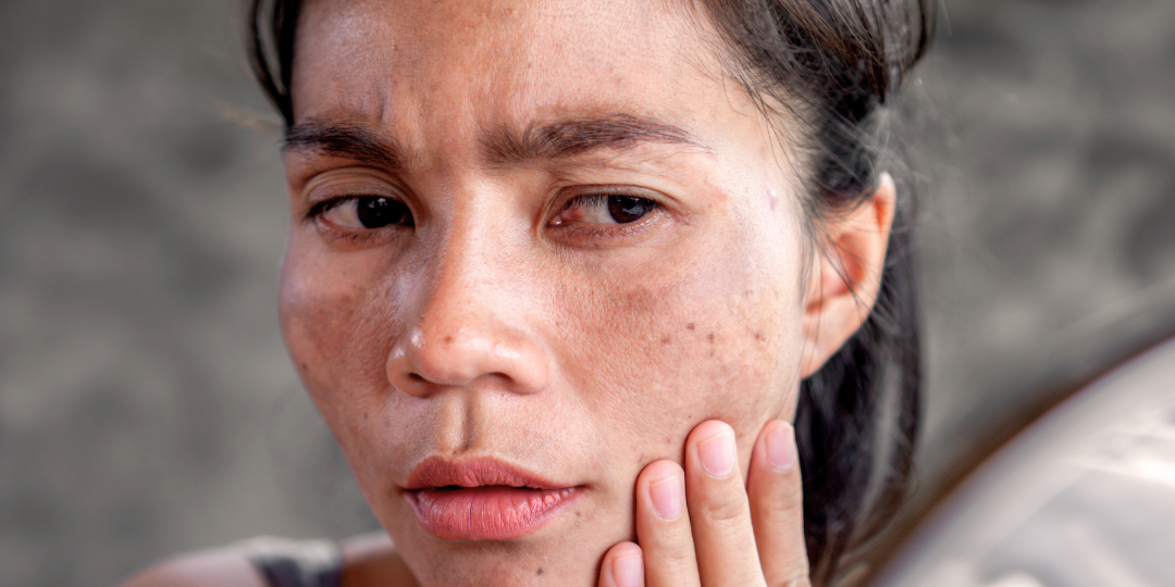 Our Clinical Power Trio: Long Lasting Solutions for Sun Spots and Pigmentation