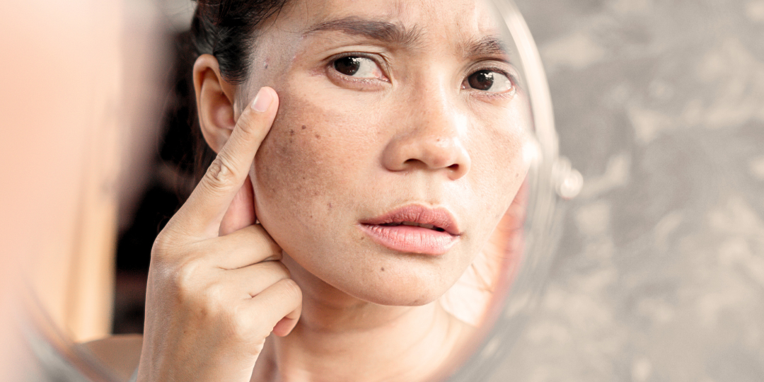 Illuminate Your Complexion: Advanced Solutions for Hyperpigmentation & Melasma