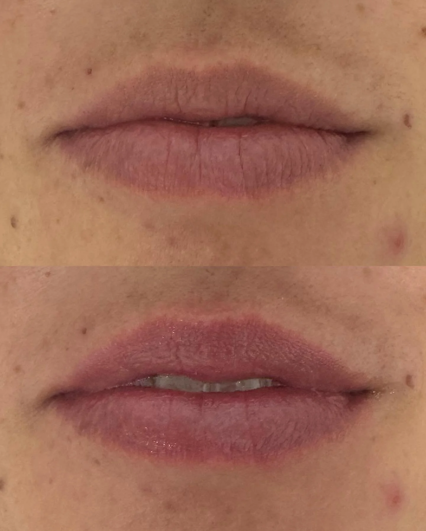 Lip Rejuvenation + Plumping 👄

these results are right atter her treatment

NO PAIN
NO NEEDLES
NO DOWNTIME
NO ANESTHETIC

Aerolase Light-based laser treatments of the lip can provide substantial plumping, color and texture improvement and significan