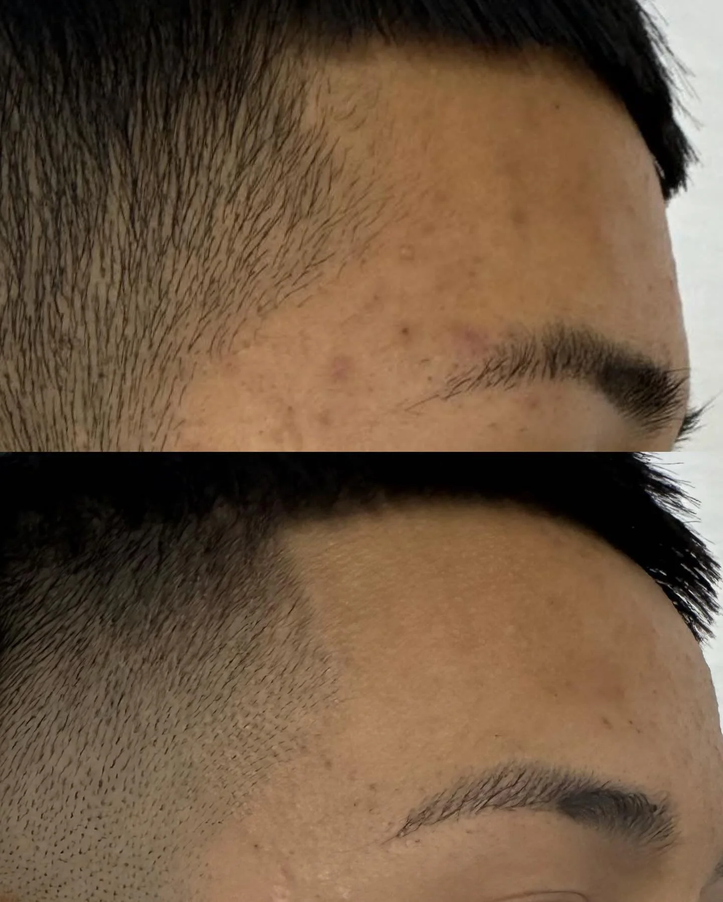 I love my job and these amazing results make me SO happy 🙌🏽

After using Aerolase for acne treatment, see how it not only targets breakouts but also fades post-acne marks (PIH). At JFB, you will achieve clearer, smoother skin one session at a time!
