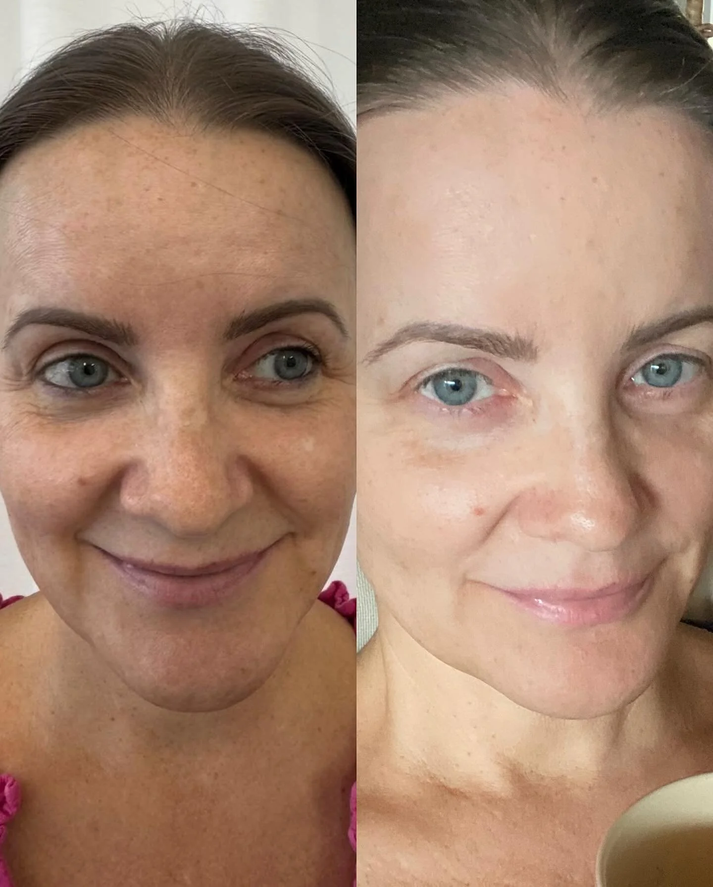 ✨ Transformative results with Aerolase ✨
it&rsquo;s not just another laser; it&rsquo;s a game changer for various skin conditions-all in ONE treatment!

Seeing my before and after pictures fills me with so much joy and happiness-sometimes it even bri