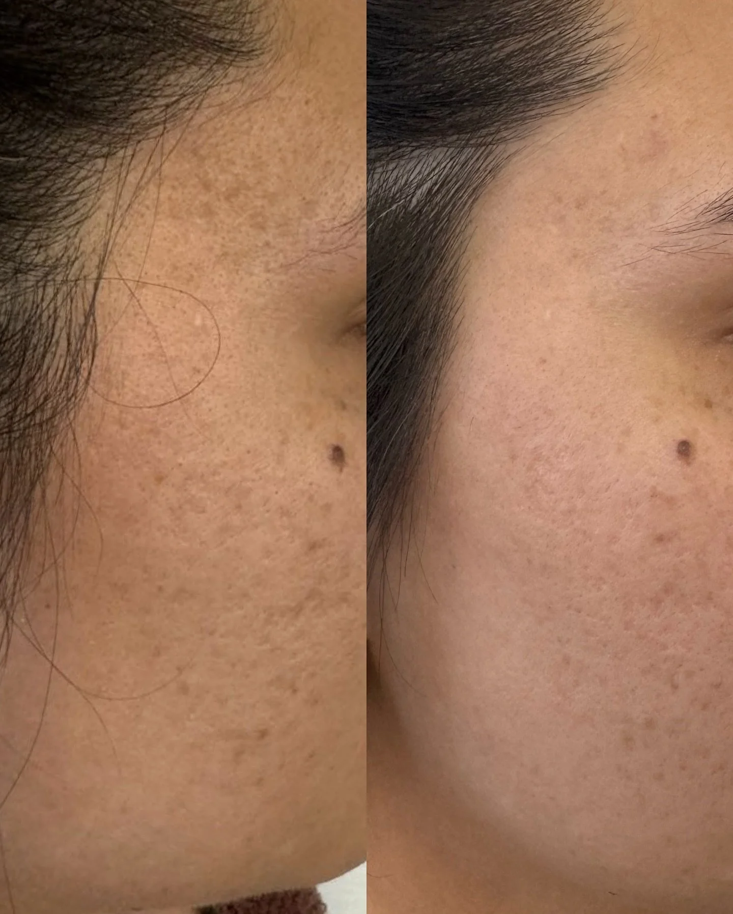 Aerolase Neo Elite = RESULTS 🙌🏽

this laser is amazing for acne, scarring, skin texture, large pores, fading unwanted pigment on the skin such as melasma, hyperpigmentation, sun spots, and more!

The key to results? Combine in-office treatments wit