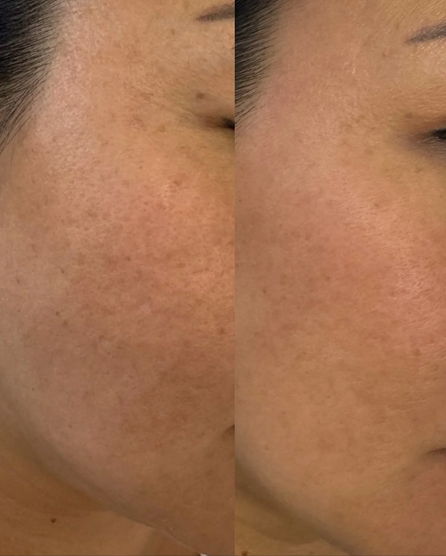 We love progress! Look at the improvement in her tone and texture after 3 aerolase treatments + 2 peels + an at-home skincare regimen. We&rsquo;re not done yet. She still has more treatments to go 🩷✨

Aerolase is my favorite laser! FDA approved, tre