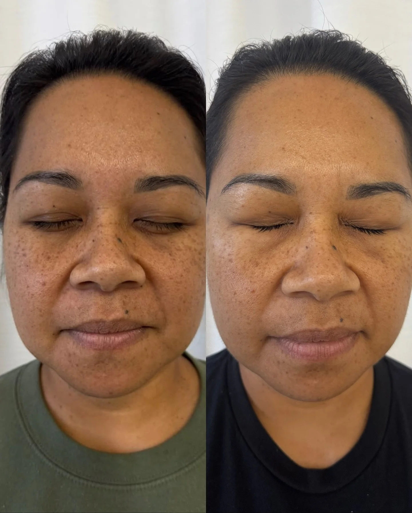 Discoloration? Dullness? Uneven tone? We don&rsquo;t do that here 💅

Aerolase #NeoElite restores your skin&rsquo;s balance by targeting pigment deep below the surface revealing that healthy, even glow you&rsquo;ve been waiting for. 

Safe for all sk