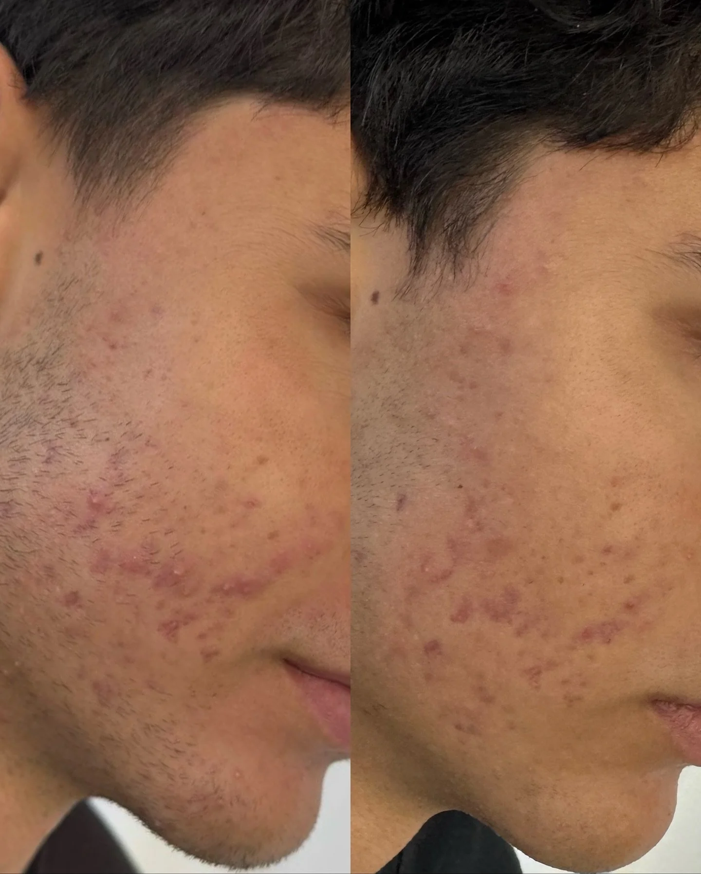 Accutane didn&rsquo;t work for him so he tried Aerolase and after his first treatment look at that difference 👏

The Aerolase Neo Elite laser targets acne-causing bacteria, calms inflammation, helps fade post acne marks (PIE and PIH) and helps fade 
