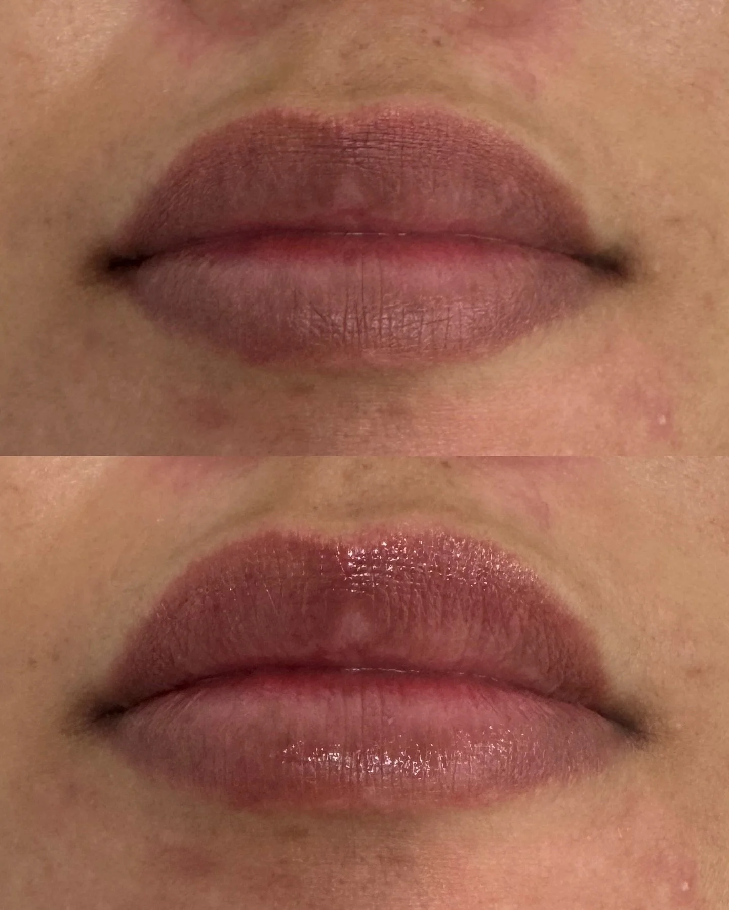 Aerolase Neo is a great alternative to fillers or
Botox 👄

NO NEEDLES | NO BRUISING | NO NUMBING CREAMS

these results are immediately after her treatment

Light-based laser treatments of the lip can provide plumping, lip rejuvenation, color and tex