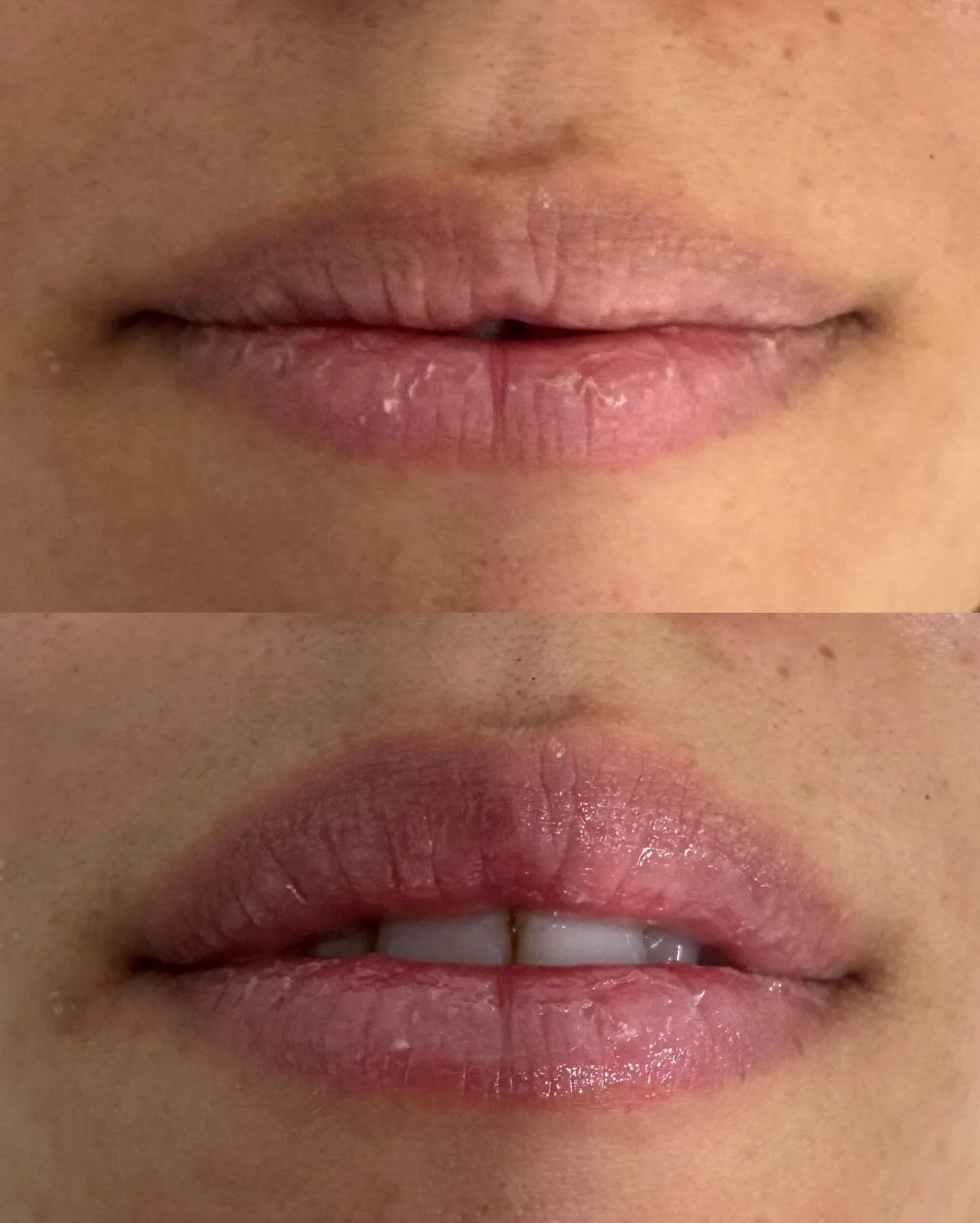 Black Friday Lip Rejuvenation Special 💋✨

Your lips deserve a glow-up too.

Aerolase gently boosts collagen around the mouth to soften fine lines, smooth texture, and bring back that natural lip color we all love.

No needles. No downtime. Just yout