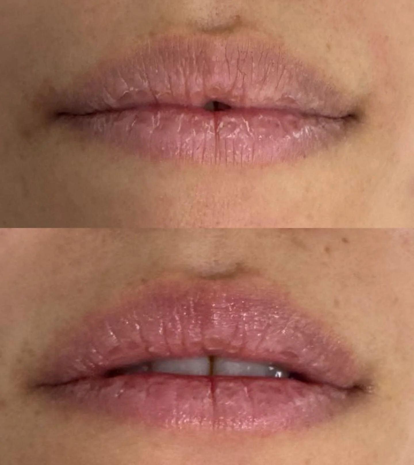 Dear Santa, kissable pink juicy lips please 💋

Instant plump, smoother lips, better color, and hydration all with Aerolase Lip Rejuvenation

NO PAIN
NO DOWNTIME
NO NUMBING CREAMS

Christmas Lip Special 5 sessions $499 

Ready for kissable lips? Book