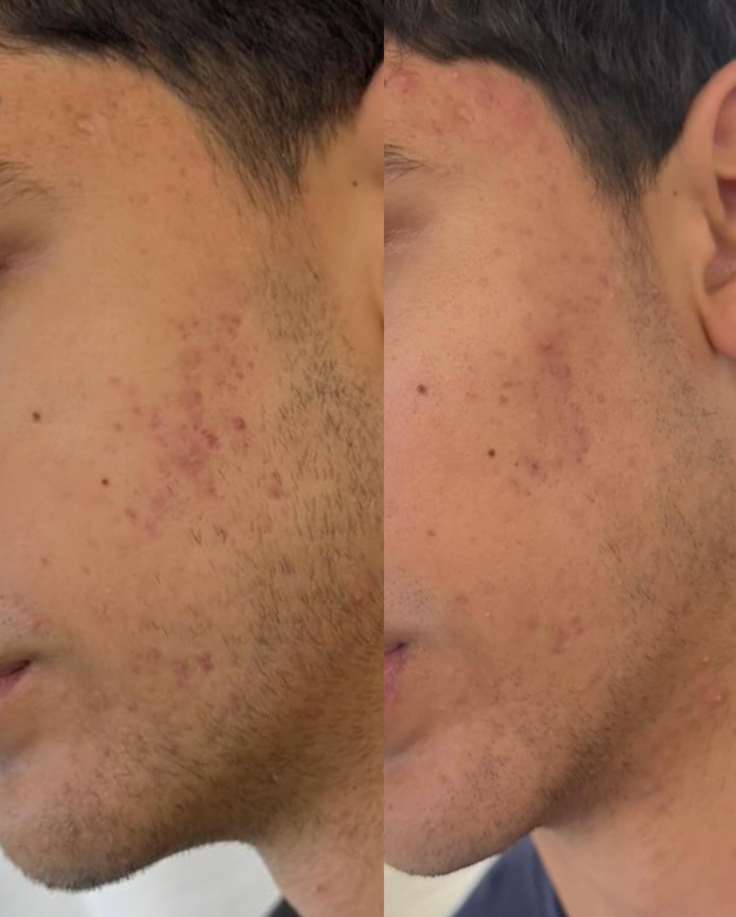 advanced acne care&hellip;

Aerolase laser combined with a customized acne peel to calm inflammation, clear breakouts, and restore balance for visibly healthier skin. This is what happens when you treat acne at the source. Consistency always eats 💅?
