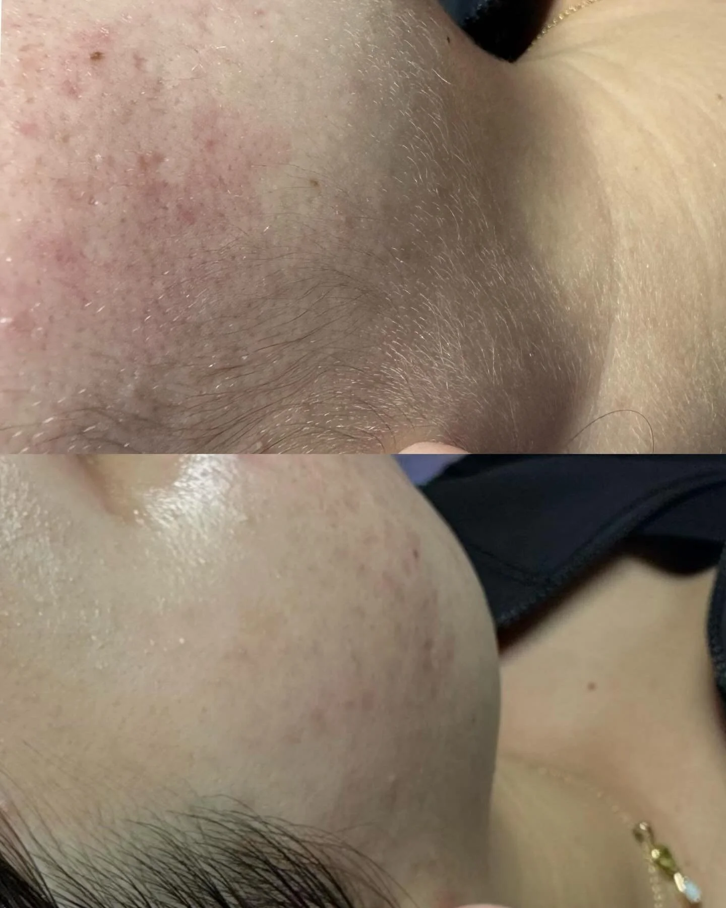 When you&rsquo;re in the right hands, your skin doesn&rsquo;t just change it transforms ✨ It&rsquo;s created through expert care, customized treatments, and consistency. Here at JFB, we focus on long term skin health, not temporary quick fixes. Healt