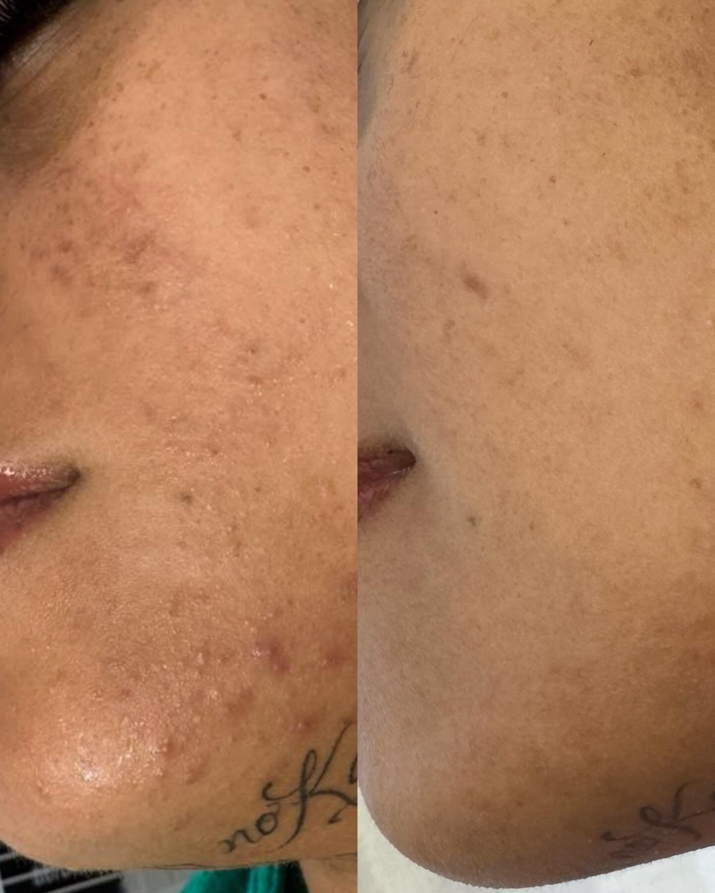 We are SO happy!!! Look at her results 😍

She completed her 6 treatment package a few months ago and this photo was taken yesterday.

Still clear
Still smooth
Still glowing

We treated the inflammation below the surface to calm redness and inflammat