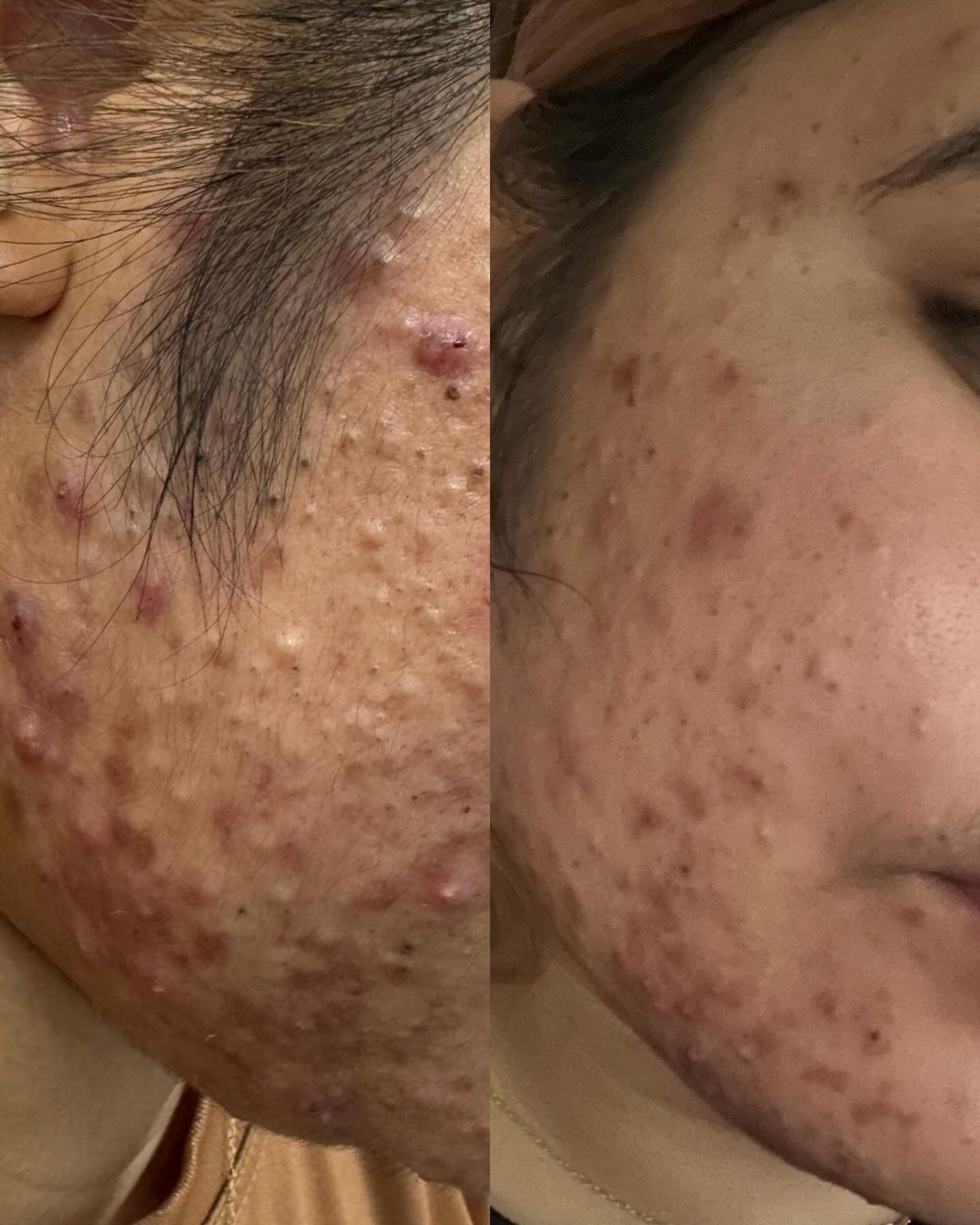 3 DAYS | ONE Aerolase session | Customized Marini Skincare Solutions at-home routine started 

Look at the reduction in inflammation
Look at the calming
Look at the progress 

Acne doesn&rsquo;t clear overnight, but this is what happens when you comb